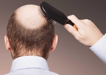 Saç niyə tökülür və keçəlliyə çarə varmı? – Mütəxəssislər izah edir