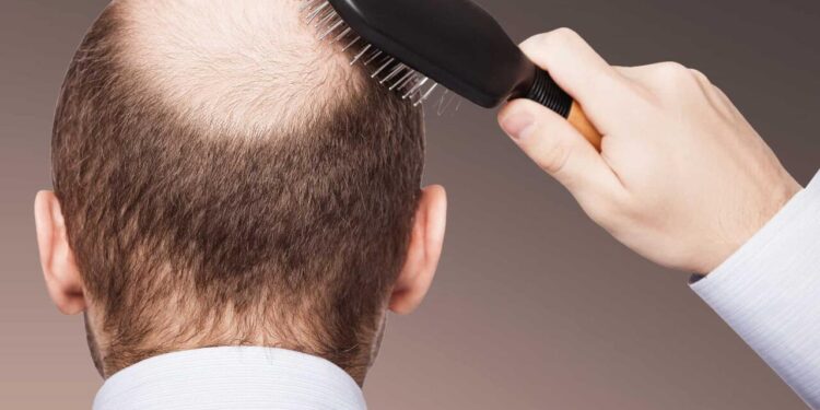 Saç niyə tökülür və keçəlliyə çarə varmı? - Mütəxəssislər izah edir