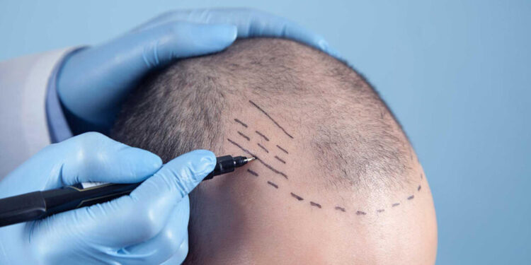 Saç transplantasiyası əməliyyatından sonra öldü