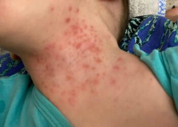 Uşaqlar arasında yeni virus yayılıb? – AÇIQLAMA