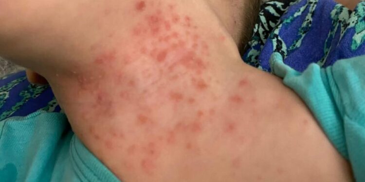 Uşaqlar arasında yeni virus yayılıb? – AÇIQLAMA