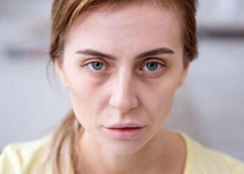 Üzün solğun olması hər zaman qanazlığı demək deyil – Həkim