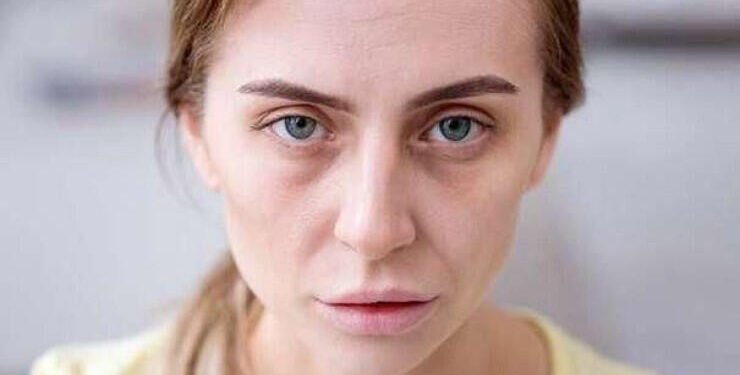 Üzün solğun olması hər zaman qanazlığı demək deyil - Həkim