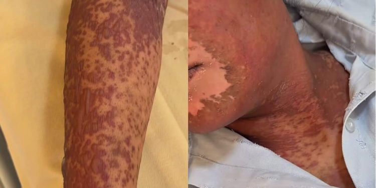Qida allergiyası necə özünü göstərir? - Həkim açıqladı