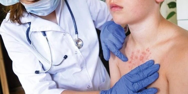 Nyu-Yorkda qızamıqla bağlı fövqəladə vəziyyət elan edildi